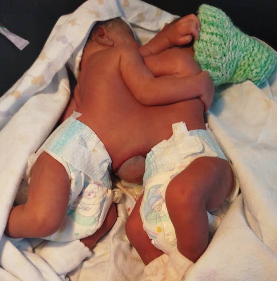 Deux bébés siamoises transférées à Mirebalais pour une intervention chirurgicale